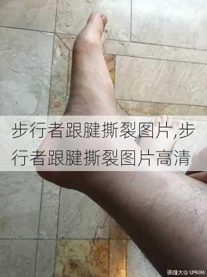 步行者跟腱撕裂图片,步行者跟腱撕裂图片高清